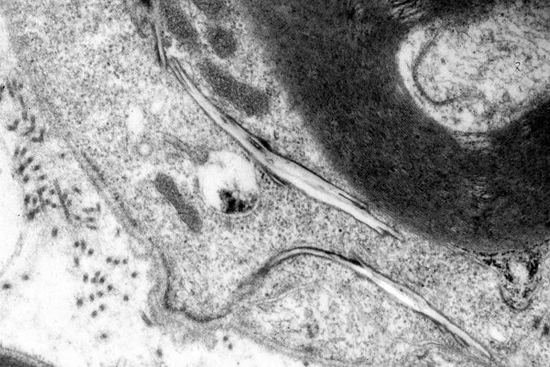 Unter dem Elektronenmikroskop zeigt sich, wie sich Cholesterin bei einer Störung des Abbaumechanismus in länglichen, kristallartigen Strukturen (Bildmitte) im Nervengewebe ansammelt. 