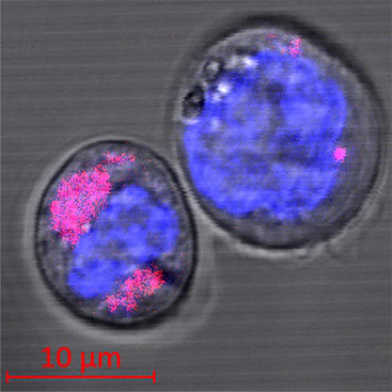 Two CD34+ stem cells containing carbon nanoparticles (coloured magenta); the cell nuclei can be seen in blue. The researchers found that the nanoparticles are encapsulated in the cell lysosomes.