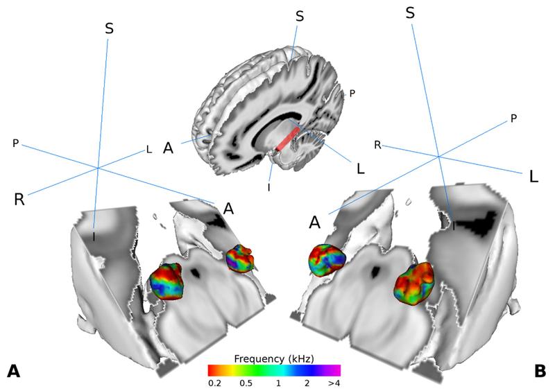 Visualization of the medial geniculate body (MGB) in the brain of human test persons.