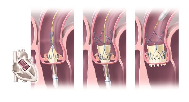 TAVI: Freisetzung einer Aortenklappenprothese.