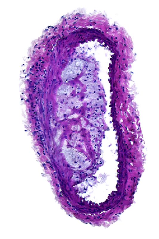 Deutlich verengt ist diese Arterie einer Maus durch eine atherosklerotische Ablagerung, an der auch Immunzellen beteiligt sind. Eine Impfung könnte dies möglicherweise künftig verhindern. 