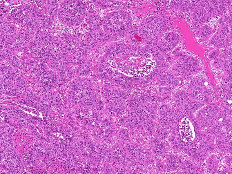 Histologisches Schnittpräparat eines primären Lungenkarzinoms. Plattenepithelkarzinome der Lunge sowie des Kopf-Hals-Bereichs lassen sich anhand ihrer Feinstruktur i. d. R. nicht unterscheiden.