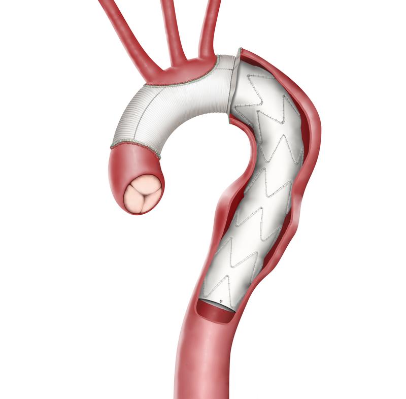 Ersatz eines Aortenabschnitts durch eine Gefässprothese.
