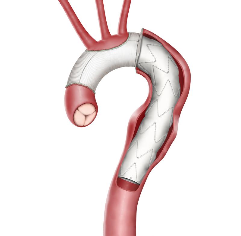 Replacement of part of the aorta with a vascular prosthesis.