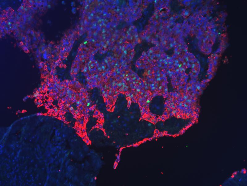 Fluoreszenzbild einer Tumorfront des Gebärmutterhals. Zellkerne wurden blau und sich teilende Zellen grün markiert. Tumorzellen, rot markiert, befallen und verdrängen gesundes Gewebe.