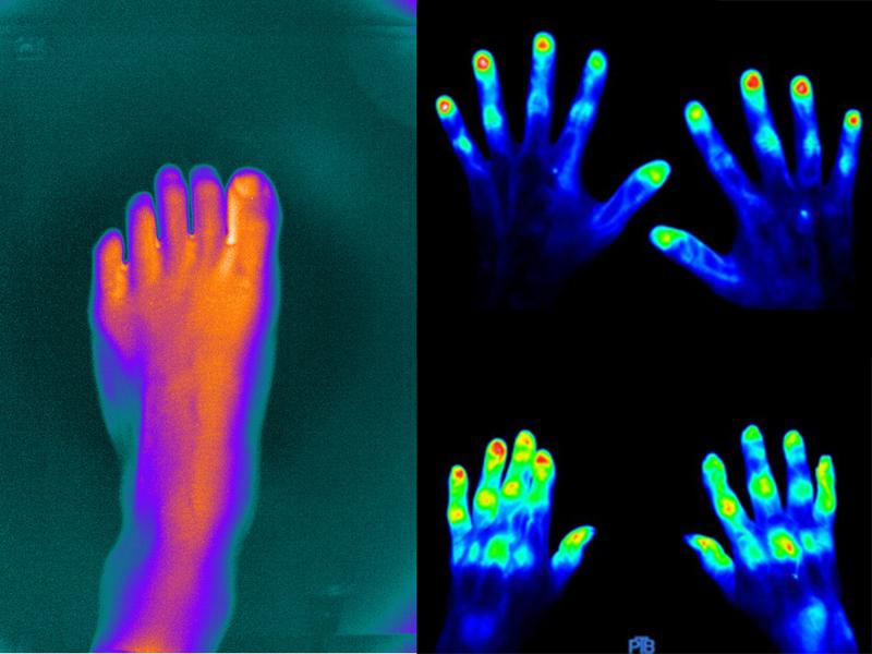 Der künstliche Fuß links zeigt natürlich keine Rheumaherde. Doch sobald die klinische Erprobung beginnt, sind Bilder zu erwarten, wie sie der Handscanner (rechts) bereits erzeugt.
