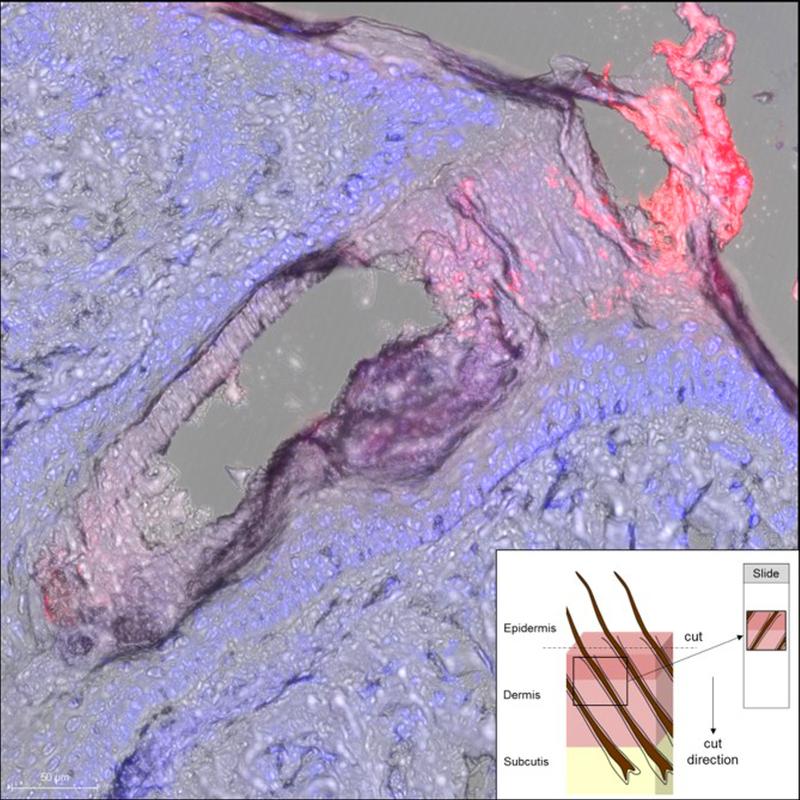 Mikroskopische Aufnahme eines längs angeschnittenen menschlichen Kopfhaarfollikels, ohne Haarschaft. Nanopartikel sind rot markiert, Zellkerne blau. Beide Farbstoffe überlagern sich am Follikelrand.