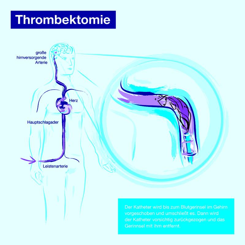 Infographik Thrombektomie (Copyright: Agentur ADVERB, Berlin)