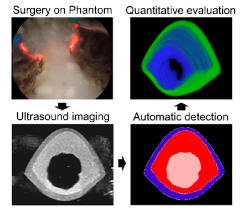 Endoscopic surgery on the human-like phantom of the prostate. For the first time, the intelligent surgical simulator makes it possible to quantitatively evaluate the surgery’s outcome. 