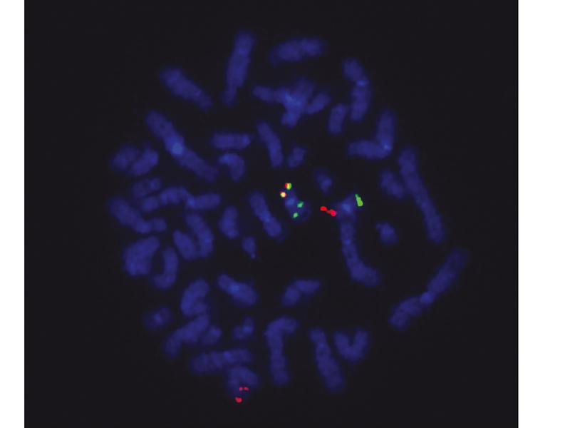 Fusionsgen in Tumorzellen: Rote Signale zeigen den ETO2-Genlokus, grüne den GLIS2- Lokus und die gelben die ETO2-GLIS2-Fusion.