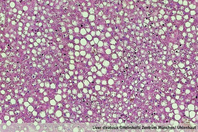 Example of fatty liver.