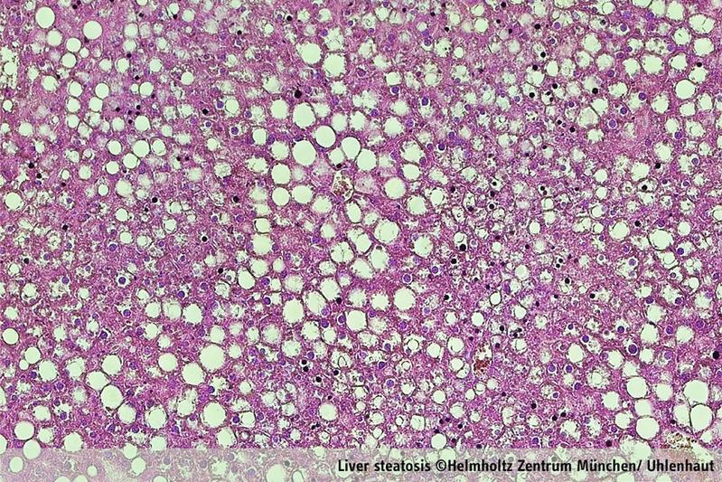 Example of fatty liver.