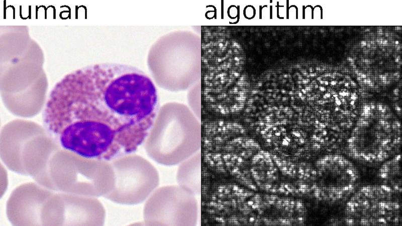 Deep-Learning-Algorithmen der KI analysieren Proben auf automatisierte und standardisierte Weise. Links: Klassifizierung menschlicher Experten. Rechts: Wichtige Pixel für die KI-Analyse.  