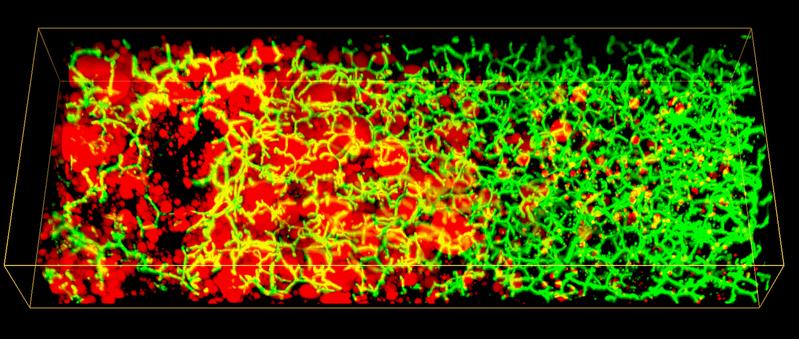 3D-Bild der Lipidtröpfchen (rot) und des Gallenkanalnetzwerks (grün) entlang der Leberläppchen eines Patienten mit nicht-alkoholischer Fettlebererkrangung (NAFLD). 