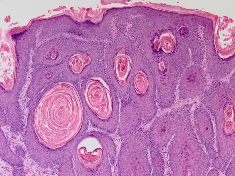 Abb. 2: Histologische Färbung eines HPV8-E7 induzierten Maushaut-Tumors. Vergrößerung 100 x