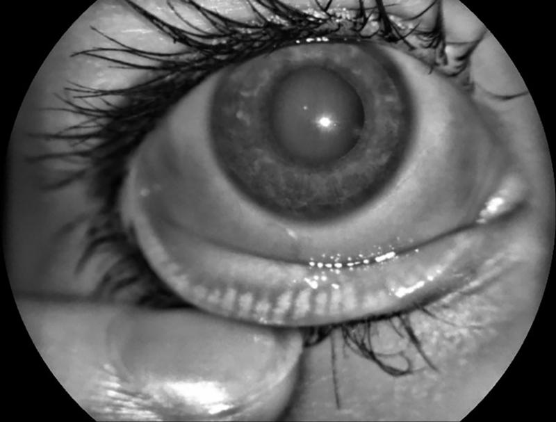 Tränenfilmrelevante krankhaft-verkürzte Meibomdrüsen (weiße Linien) sichtbar am unteren Rand der Unterlid-Innenseite des Auges (weißliche Linien, Aufnahme unter Infrarot-Beleuchtung)