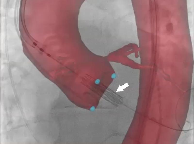 Überlagerung der dreidimensionalen Anatomie (rot) der Aorta über der Röntgenfluoroskopie im Verlauf einer transkutanen Aortenklappenimplantation (TAVI)