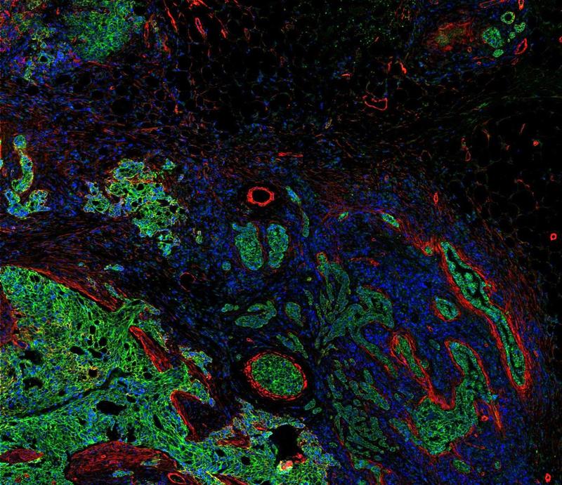 35 Biomarker ergeben eine zelluläre Landschaft des Tumors und des umliegenden Gewebes.