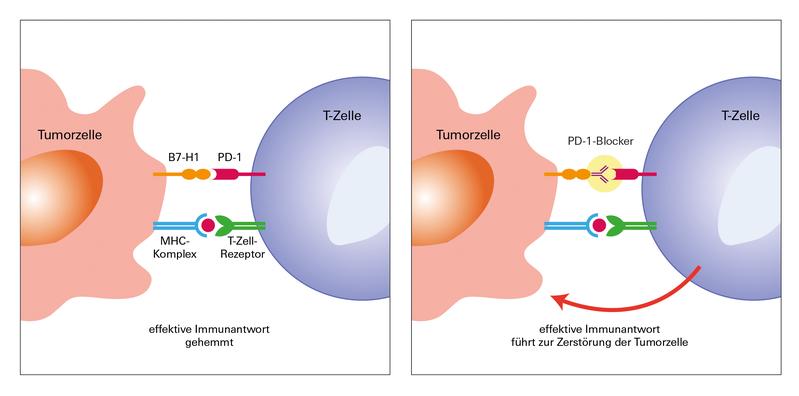 So wirkt die PD-1-Blockade prinzipiell. Bei Patienten mit fortgeschrittenem Melanom ist der Therapieerfolg allerdings nicht immer gleich gut.