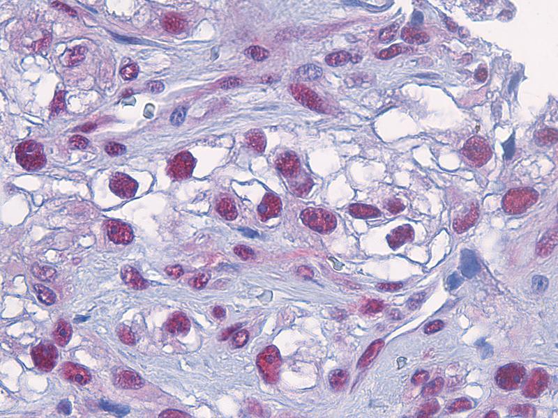 Blick in Tumorgewebe des malignen Melanoms: Das Enzym Caspase 8 (dunkelrote Punkte) reichert sich in den Zellkernen an und aktiviert den für Patienten fatalen Überlebensmechanismus der Zelle.