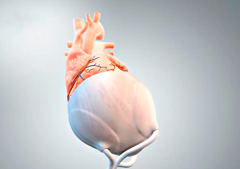 The first application of the pericardium replacement material is to produce a new type of surface for an extravascular cardiac support system using 3D printing.