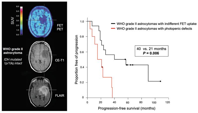 Patient mit niedriggradigem hirneigenen Tumor, der einen sog. photopenischen Defekt in der FET-PET (links oben) und somit eine deutlich ungünstigere Prognose (vgl. Überlebenskurve rechts) aufweist.
