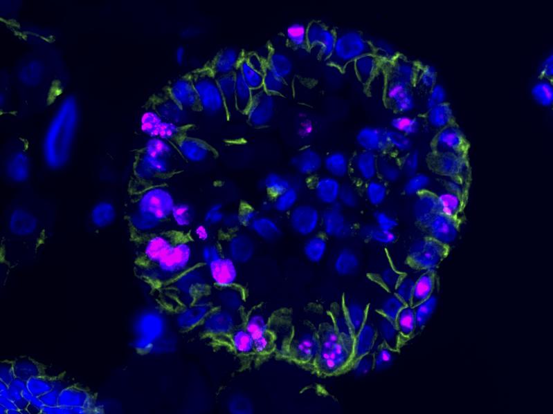 Menschliche ccRCC-Organoide unter dem Mikroskop, markiert mit fluoreszenten Farbstoffen.