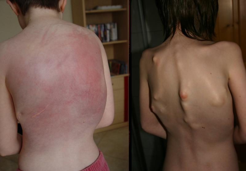 FOP-Schübe kündigen sich oft durch Entzündungen an, der Rücken des Patienten ist stark geschwollen und gerötet. (Bild links) Zurückbleibende FOP-Verknöcherungen am Rücken. (Bild rechts)