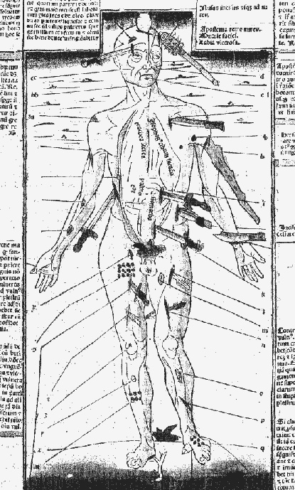 Der Würzburger "Wundenmann", eine Darstellung aus dem Jahr 1495, zeigte den Ärzten des Mittelalters, welche Waffen welche Verletzungen hervorrufen und wie diese zu behandeln sind. Quelle: "Fasciculus medicinae", Venedig, Gebrüder Gregorii.