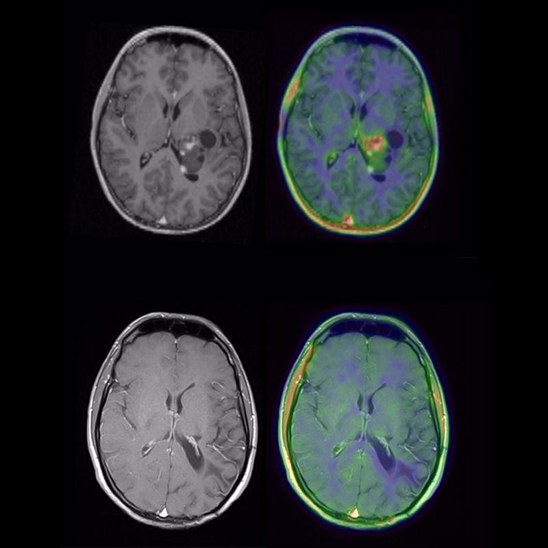 MRT eines Patienten mit Glioblastom vor (oben) und nach (unten) molekularer neuropathologischer Diagnostik und zielgerichteter Therapie.