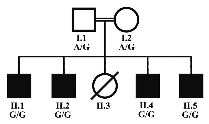 Stammbaum der Familie mit vier betroffenen Söhnen, die von Vater und Mutter die Mutation geerbt haben. Die Eltern zeigen jeweils eine defekte (G) und eine wild-typische (A) Genkopie. 