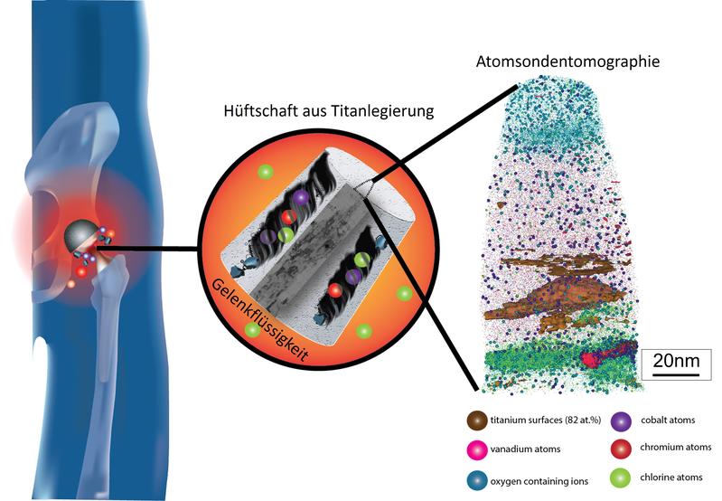 Der kobalthaltige Hüftkopf kann sich an der Verbindungstelle zum Hüftschaft aus einer Titanlegierung durch Reibung abbauen. Mittels Atomsondentomographie analysierte das MPIE-Team den Reibungsprozess