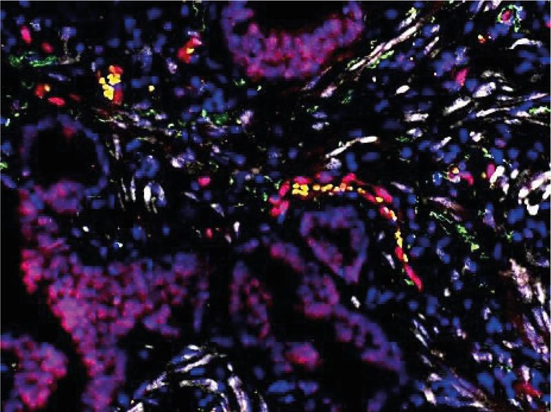 Die neuartige Färbetechnik ermöglicht die gleichzeitige Darstellung und Untersuchung von miRNAs (weiß) und ihren regulierten Zielproteinen (rot) auf Ebene der Einzelzellen (blau; Zellkerne).