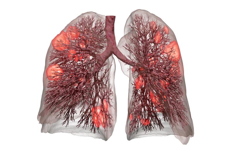 Utilizing the data of a CT lung scan, the software uses artificial intelligence to calculate the actual condition of a patient’s lungs. Damage caused by a COVID-19 infection is marked in orange.