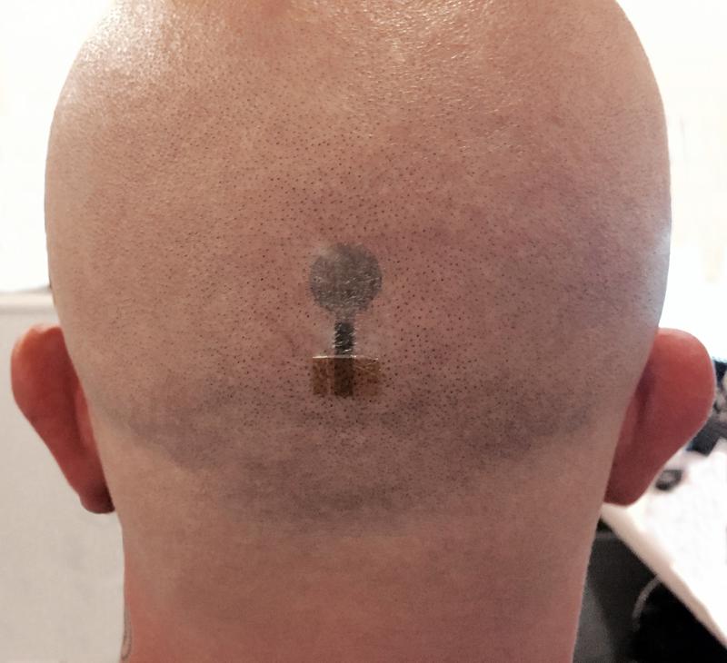 Die Zuverlässigkeit und Genauigkeit der Tattoo-Elektroden wurde unter realen klinischen Bedingungen erfolgreich getestet.