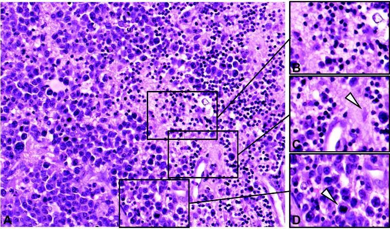 Charakteristisches histopathologisches Bild eines primären Lymphoms des Zentralnervensystems