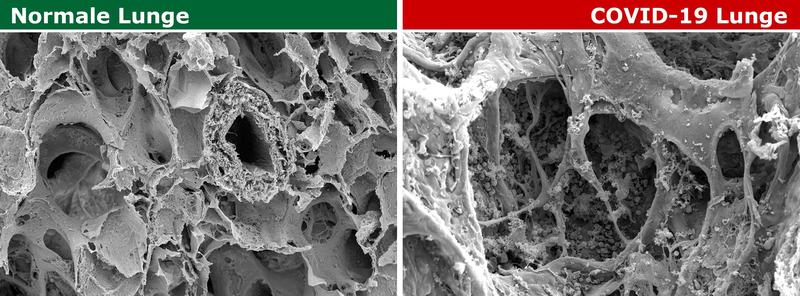 Gesunde und von COVID-19 angegriffene Lunge