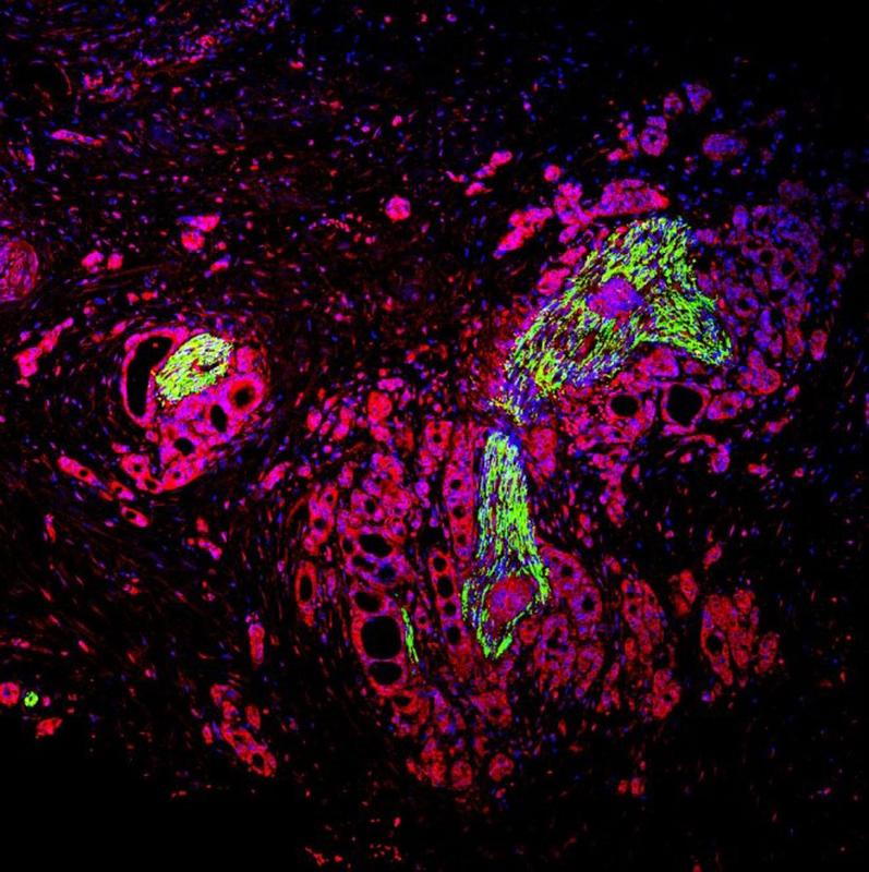 Gewebeanalyse eines am Pankreaskarzinom erkrankten Patienten: Tumorzellen (rot) wachsen in einen Nerv (grün) ein.