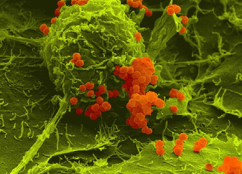 False color scanning electron micrograph of meningococci (orange) adherent to human host cells (green).