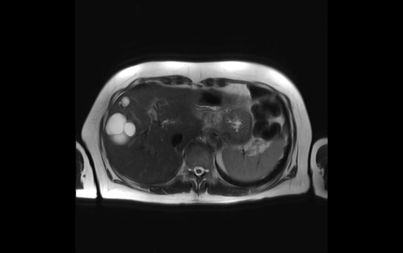 Querschnitt durch einen Oberkörper: Auf diesem MR-Bild sind links am Rand mehrere Zysten der Leber als weiße Blasen zu erkennen.