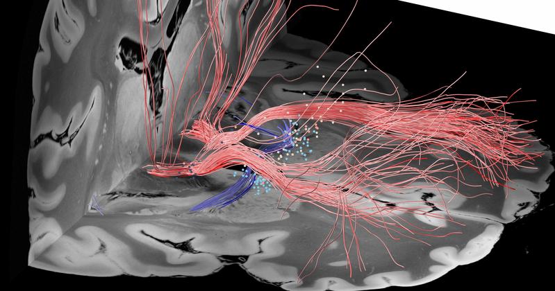 Fasertrakte im Zielgebiet der Hirnstimulation: Dargestellt sind die Elektrodenkontakte bei 50 Patienten mit Zwangsstörungen sowie stimulierte Fasern mit positiven (rot) und negativen (blau) klinischen Ergebnissen.