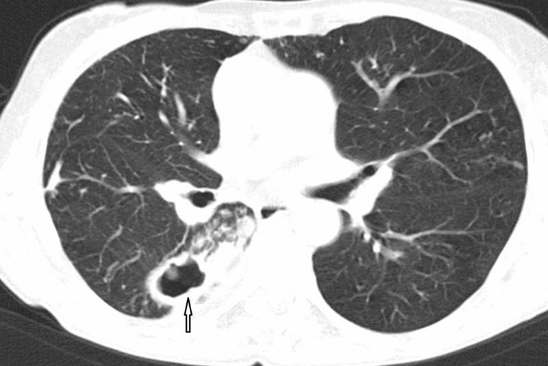 Computertomographie des Brustkorbs bei einer Patientin mit einer kavernösen (Pfeil)  Infektion der rechten Lunge durch Mycobacterium avium.