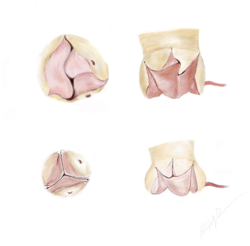 Illustration der Ozaki-Klappe. Oben: die Ozaki-Klappe in der Ansicht von oben (links) und seitlich (rechts) Unten: die normale Aortenklappe von oben und seitlich. 