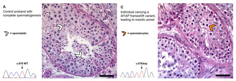 Histologie: Querschnitt durch den Hoden eines Mannes mit normaler Spermienbildung (A) und eines Mannes mit M1AP-Mutation (B).