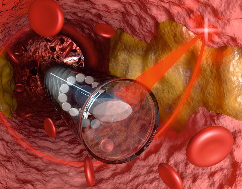 3D printed miniature endoscope optics inside a blood vessel. 