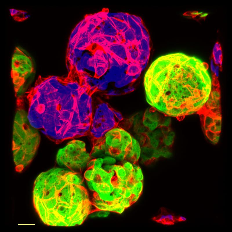 Mikrocarrier (grün und blau), die mit humanen Mesothelzellen (rot) bedeckt sind und in vitro Adhäsionen bilden. Gestresste Mesothelzellen binden sich über Zell-Zell-Kontakte aneinander und verkleben die Mikrocarrier miteinander. 