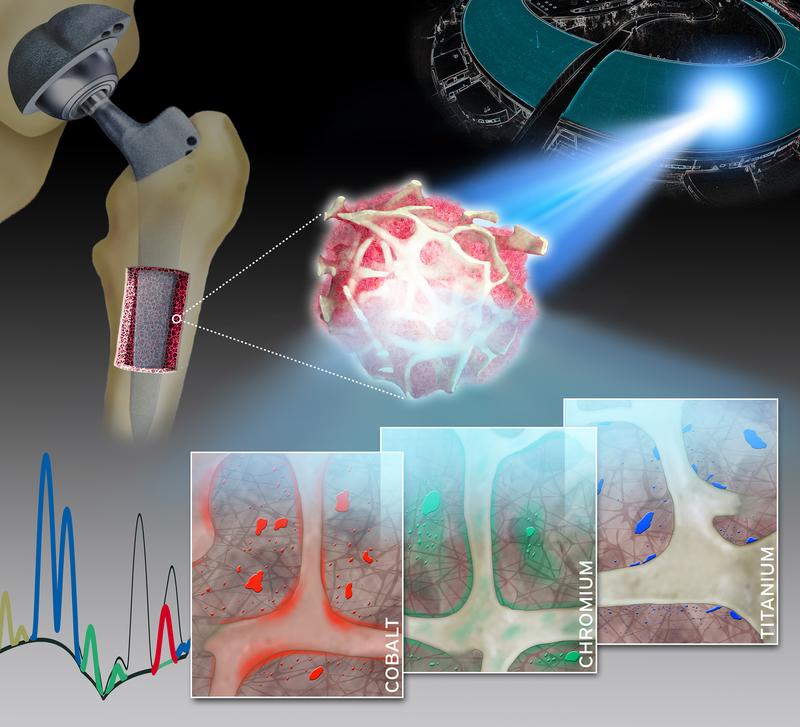 Räumlich hochaufgelöste Synchrotron-Röntgenfluoreszenzanalysen von humanen Knochen- und Knochenmark-Biopsien: spezifische Verteilungsmuster von Metallen (Kobalt, Chrom und Titan), die aus Legierungen von Endoprothesen freigesetzt werden.