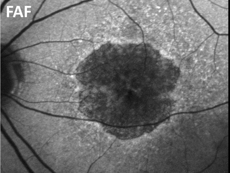 Fundus-Autofluoreszenz (FAF): Aufnahme des Augenhintergrunds bei geographischer Atrophie - dient als Referenz für die Optische Kohärenztomografie (OCT). 