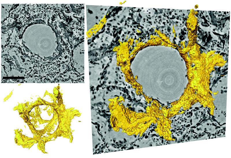Schnitte durch das dreidimensionale Rekonstruktionsvolumen (links oben, grau) um ein Lungenbläschen mit Hyalinmembran (links unten, gelb), rechts eine Überblendung. Im Zentrum befindet sich das Luftbläschen (Alveole).