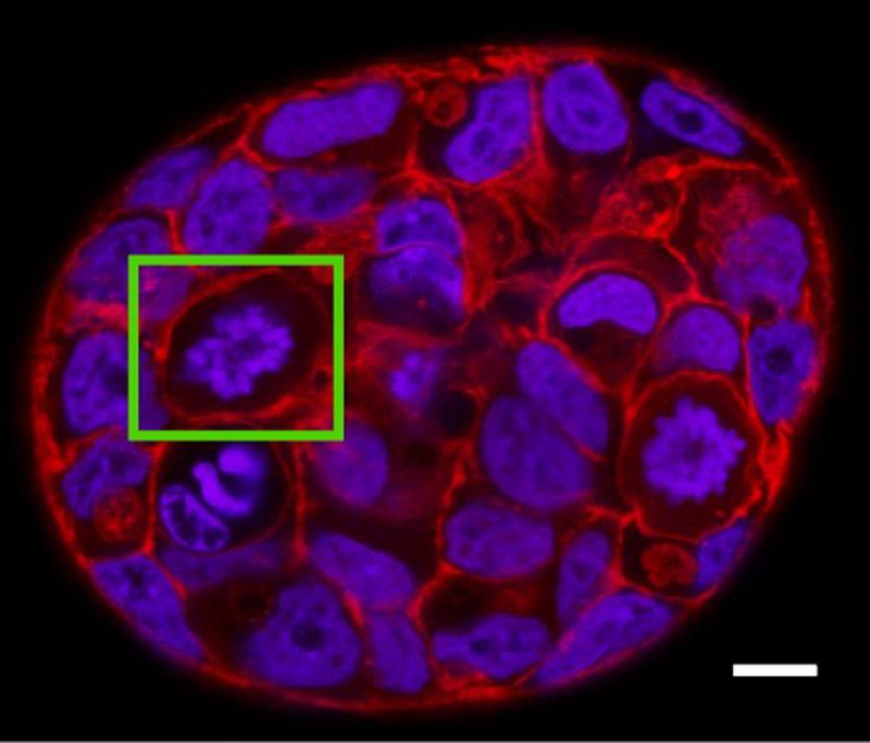 Ein Mini-Tumor aus menschlichen Brustkrebszellen (MCF-7). Grün: eine sich teilende Zelle.